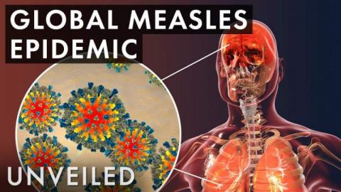 What If The Measles Outbreak Was Worldwide?