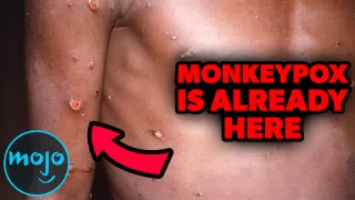 Top 10 Things You Need to Know About MonkeyPox